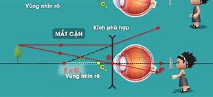 Bài Tập Mắt Cận